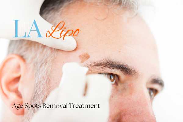 What Are the Most Effective Treatments for Age Spots Birchfield?