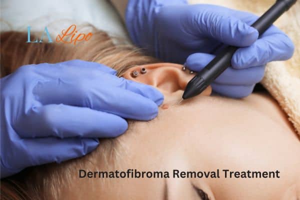 Dermatofibroma Removal Treatment Birchfield