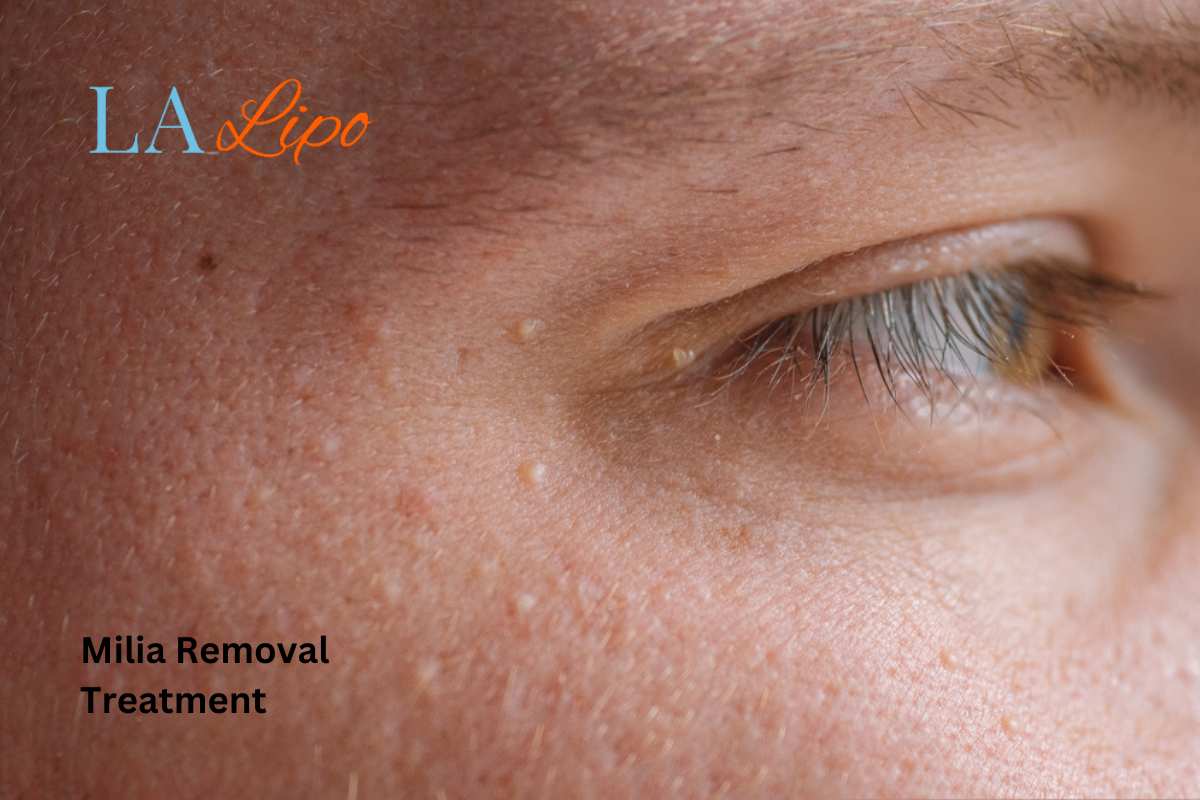 Cryopen Milia Removal: Is It the Easiest and Safest Option Birchfield?