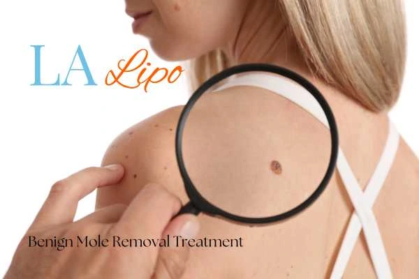 Woman having her inspection of blemish before mole removal Birchfield