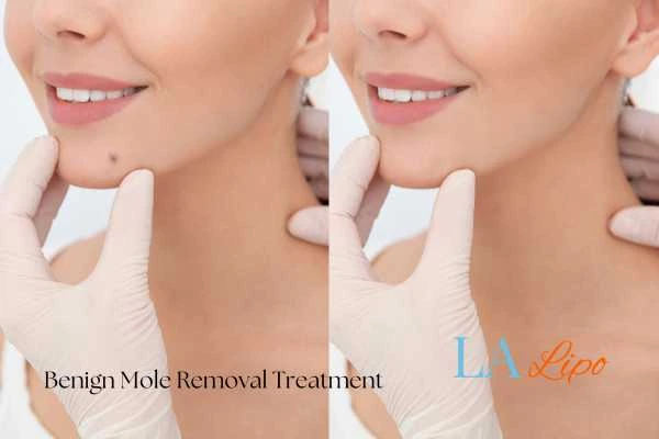 woman's before and after mole removal Birchfield results