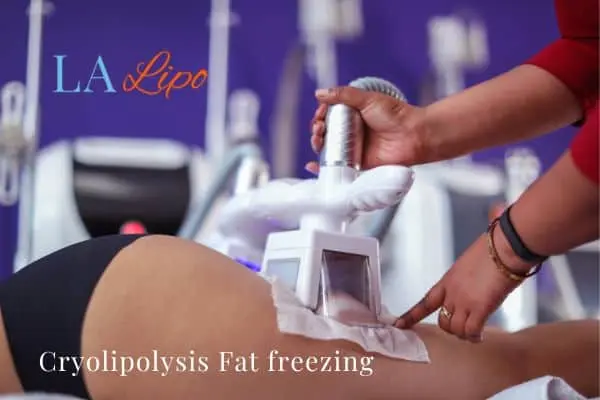 women getting fat freezing Birchfield