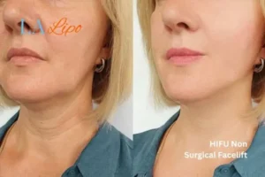 hi-fu for wrinkles Birchfield before and after results