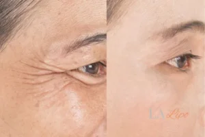 Before and after results of woman - HI-fu wrinkles reduction treatment Birchfield