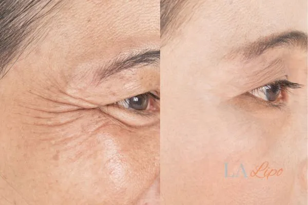 Before and after results of woman - HI-fu wrinkles reduction treatment Birchfield