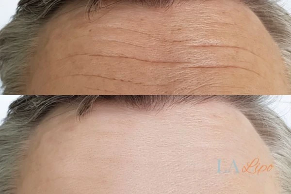 results of HIFU Birchfield on mans forehead to help reduce lines and wrinkles