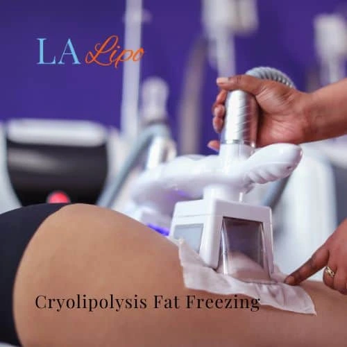 fat freezing - Cryolipolysis Birchfield