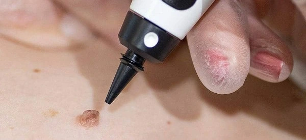 skin tag removal using cryopen Birchfield