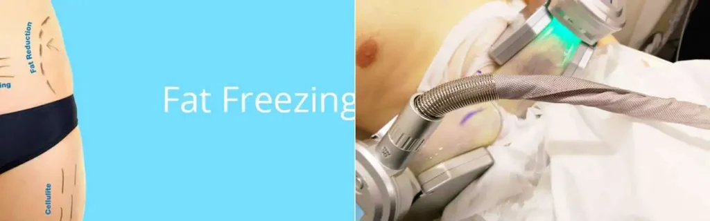 multi areas of a persons body having coolsculpting Birchfield treatment