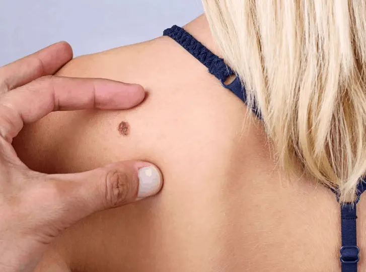 woman having mole removal Birchfield consultation before treatment.