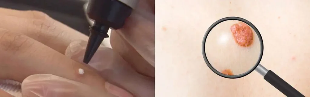 Cryopen for mole removal Birchfield - speak to our team today!