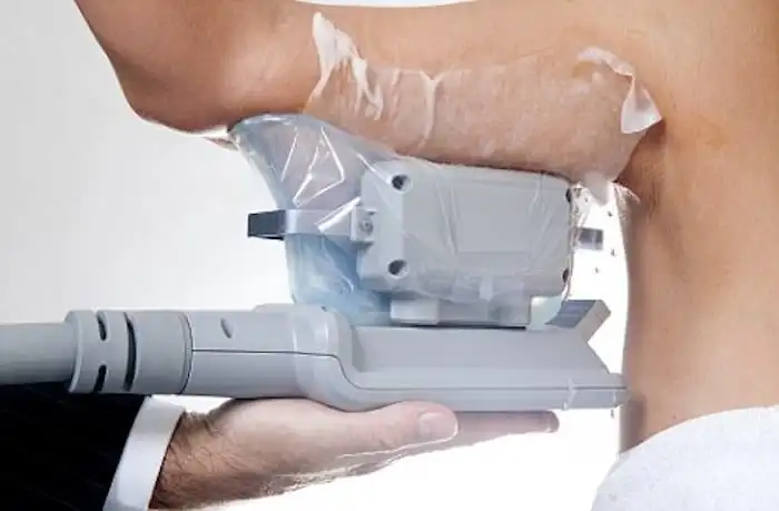 Picture of fat freezing Birchfield on the upper arms.