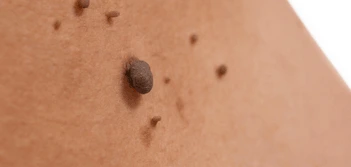 image of a skin tag Birchfield