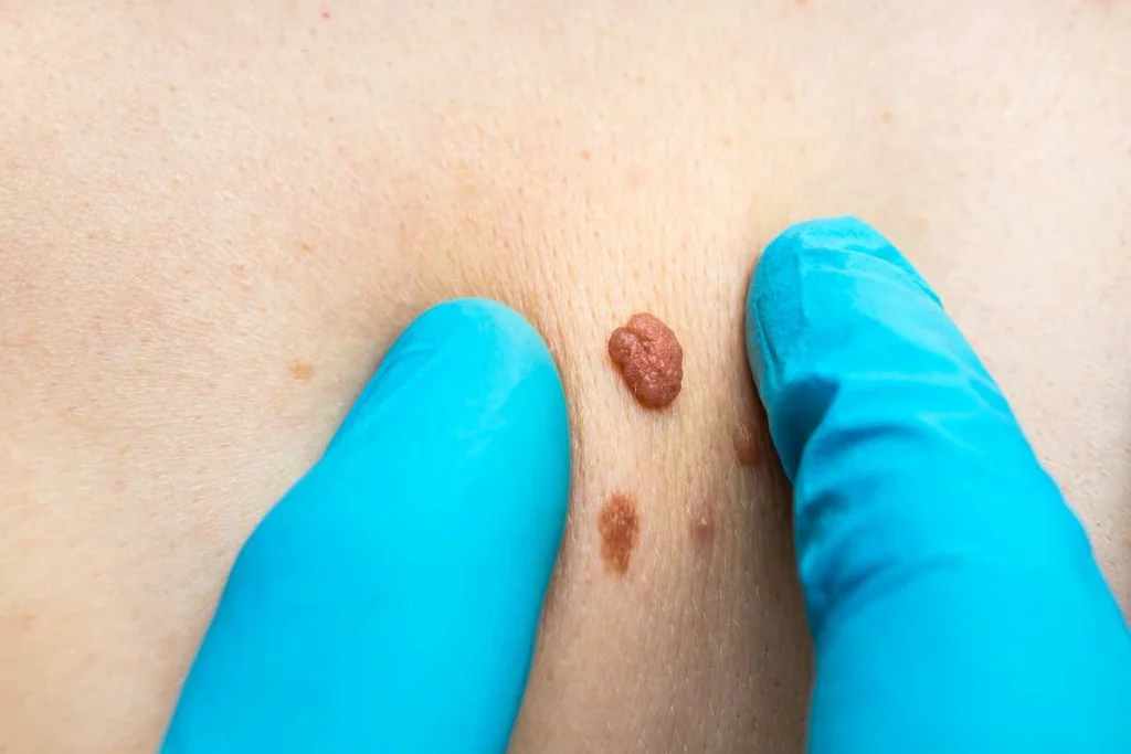 Consultant examining a skin tag Birchfield