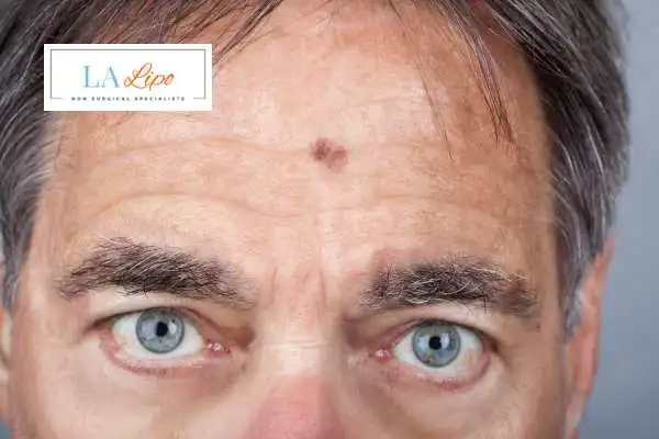 Solar Lentigo Removal Birchfield image of man with mark on his forehead