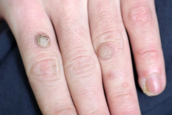 photo of warts on person hand - see wart removal Birchfield from LA LIPO