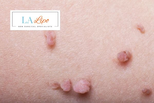 Does cryopen skin tag removal Birchfield hurt? Find out now call our team today!