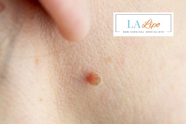 Book skin tag removal Birchfield today speak to our team now!