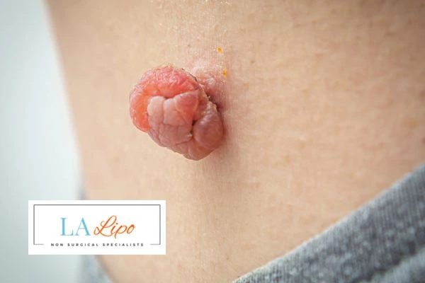 Interested in skin tag removal Birchfield? Concerned about the pain? Find out more today!