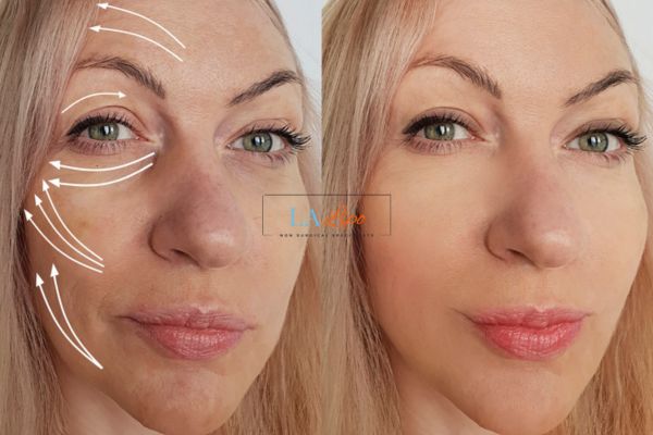 Morpheus 8 results Birchfield face lift.