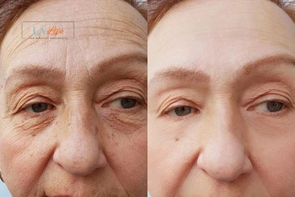The powerful benefits of Morpheus8 Treatment Birchfield - Call Our team today!