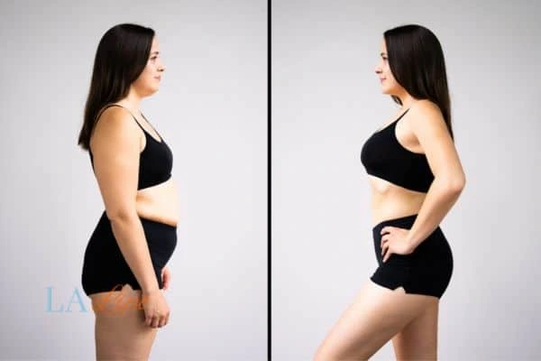 Picture of womans before and after using LA-EMS body sculpting to improve her core strength Birchfield