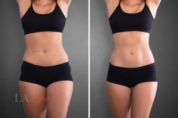 before and after results of non-surgical treatment to help a woman's body image and mental health Birchfield