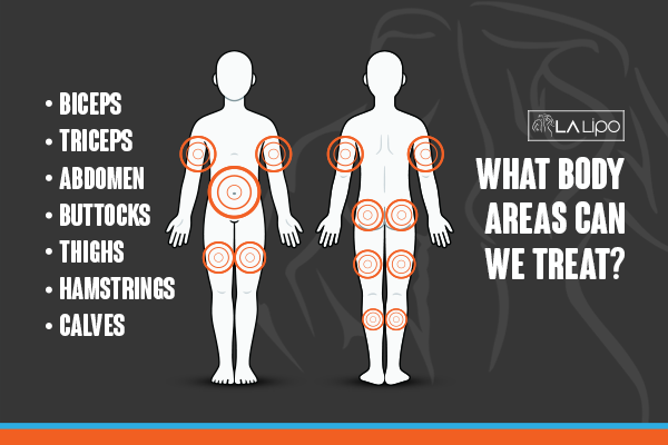Diagram to show areas you can have LA-EMS Body Sculpting Treatment Birchfield