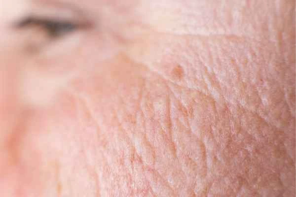 close up picture of a woman's face showing an age spot Birchfield