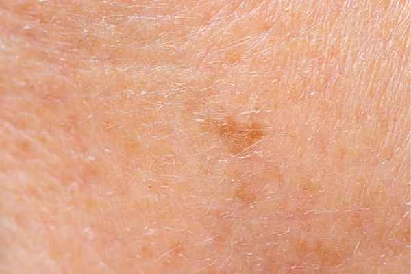 close up picture of age spots Birchfield
