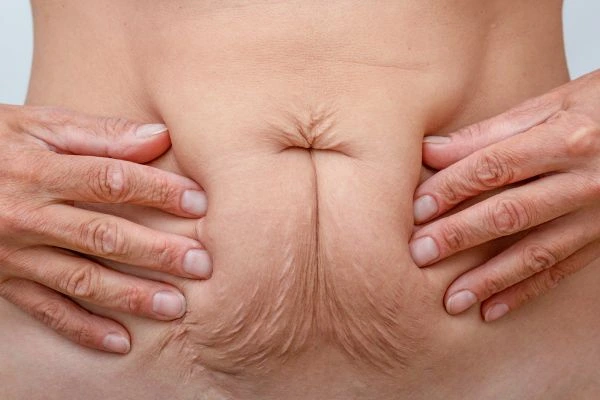 Image of a woman's stomach with loose skin - example of skin tightening Birchfield options