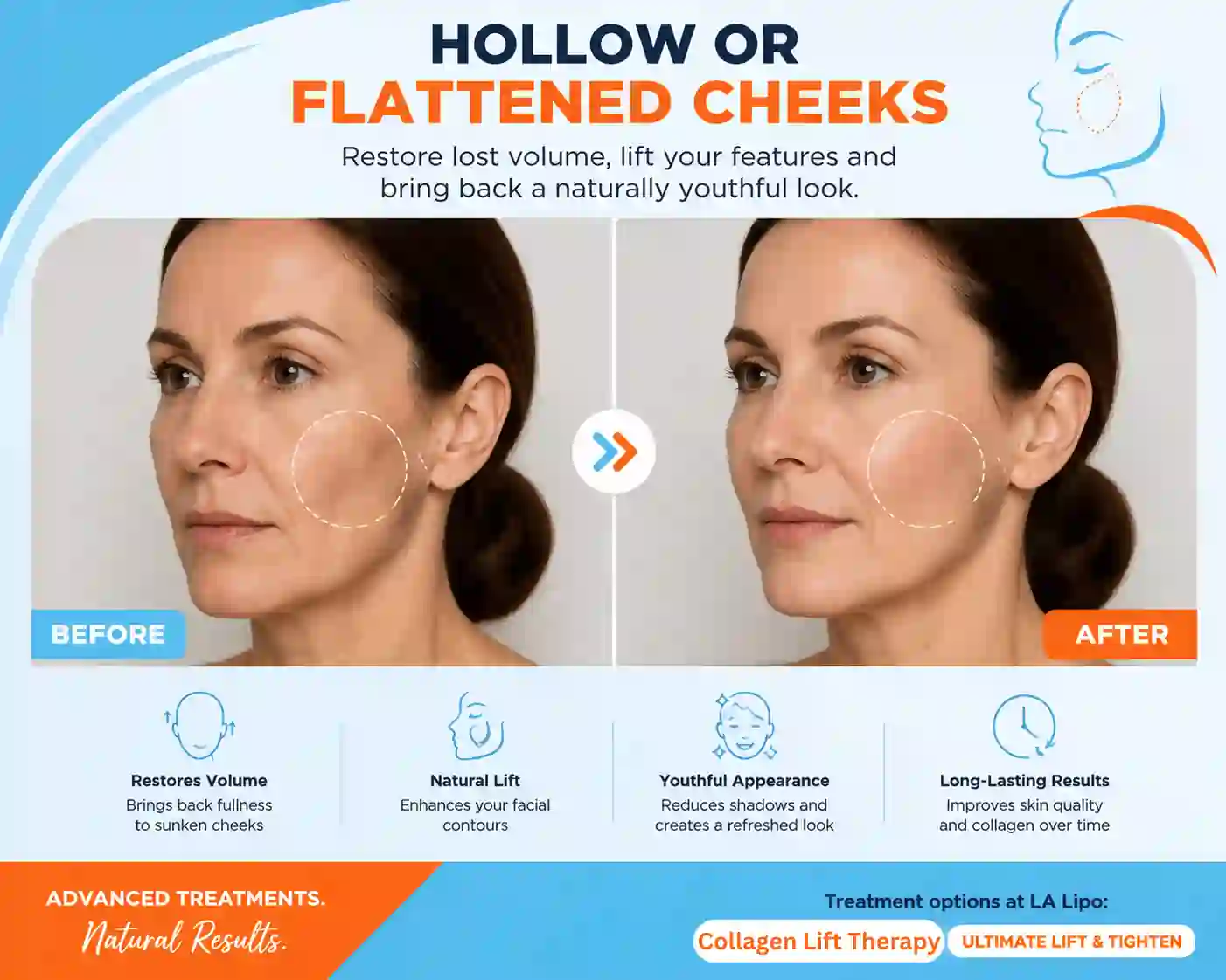 Sign #4: Hollow or Flattened Cheeks Birchfield